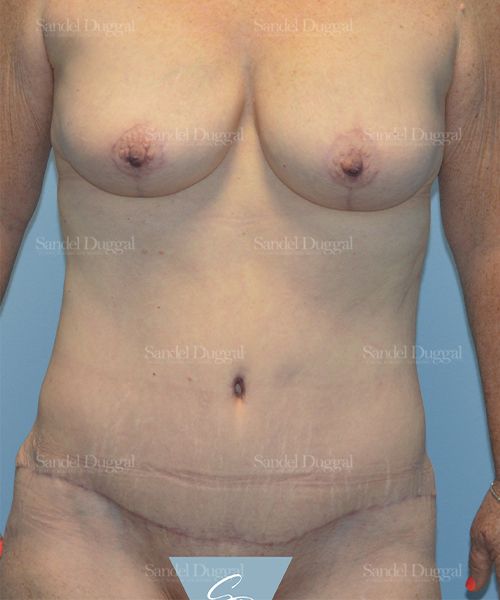 Tummy Tuck after, case 1519