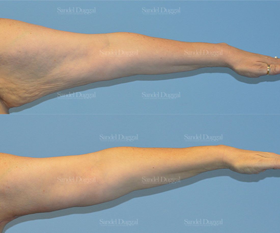 Brachioplasty before and after, case 2123