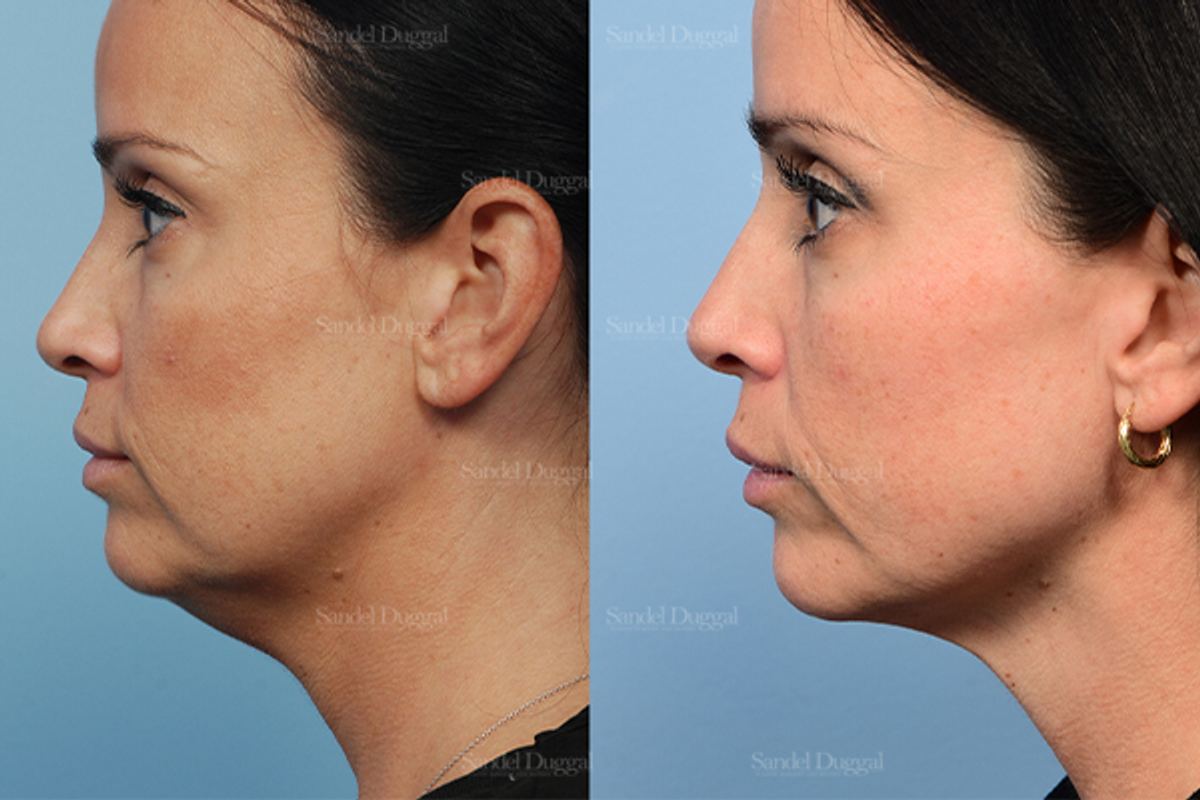 Neck & Chin Liposuction before and after, case 2554