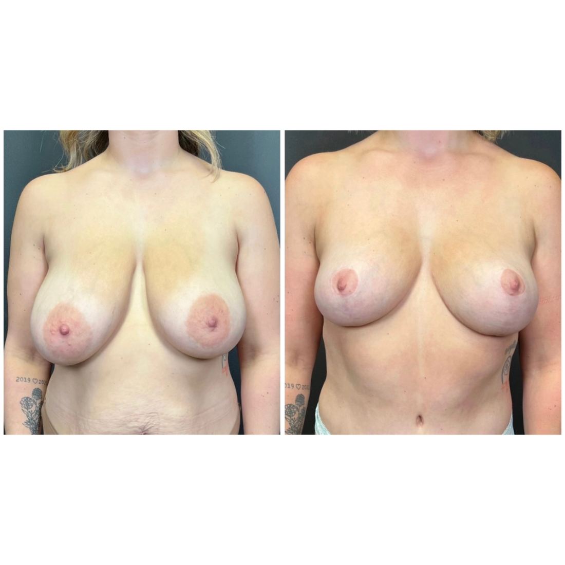 Breast Lift before and after, case breast-lift-new-07