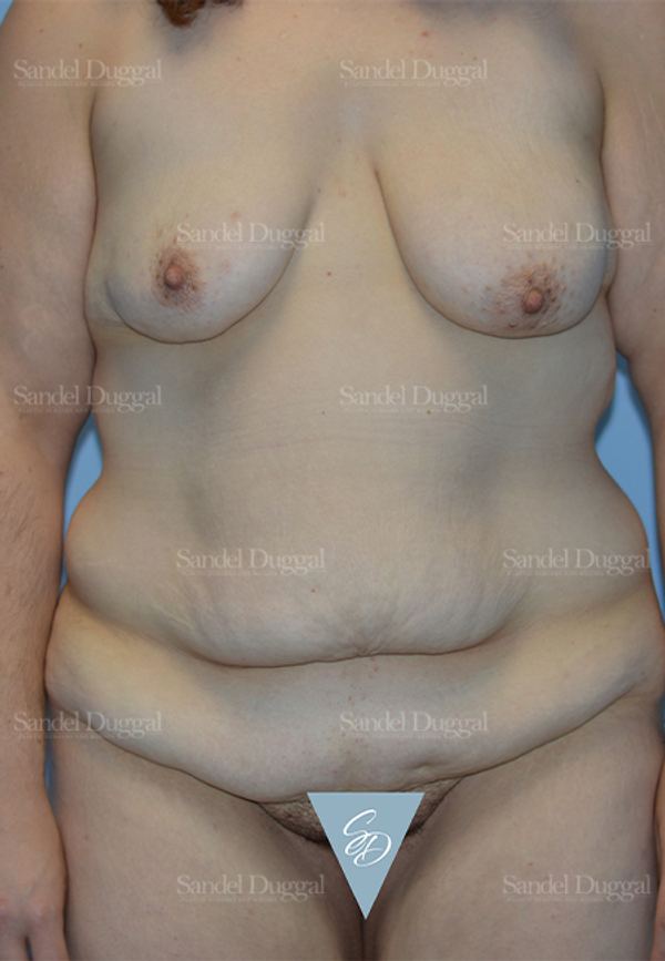Mommy Makeover before, case 2183