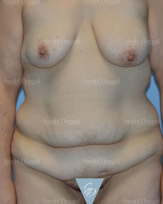 Mommy Makeover before, case 2183