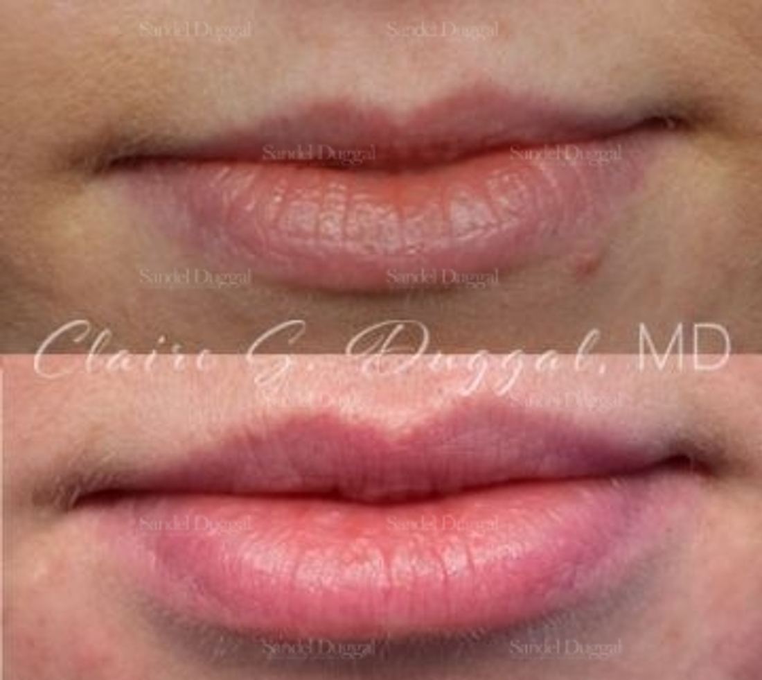 Lip Augmentation / Lip Lift before and after, case 4357