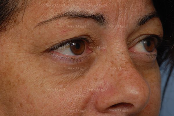 Eyelid Rejuvenation before, case 1922