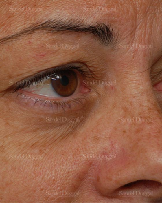 Eyelid Rejuvenation before, case 1922
