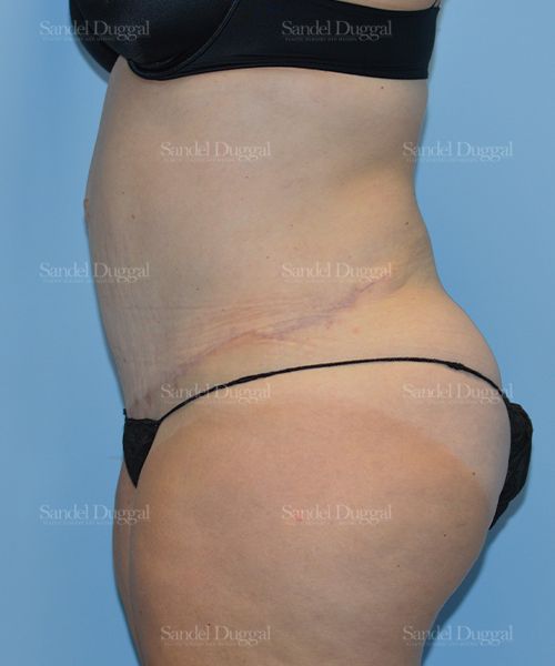 Tummy Tuck after, case 1673