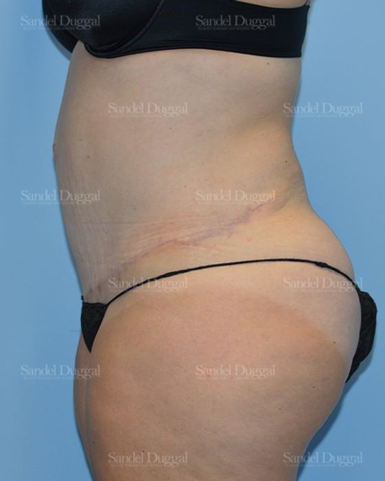 Tummy Tuck after, case 1673