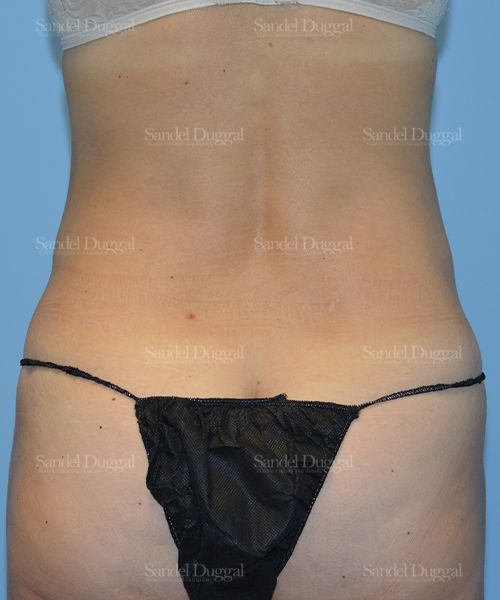 Liposuction — Legs & Flanks after, case 2526