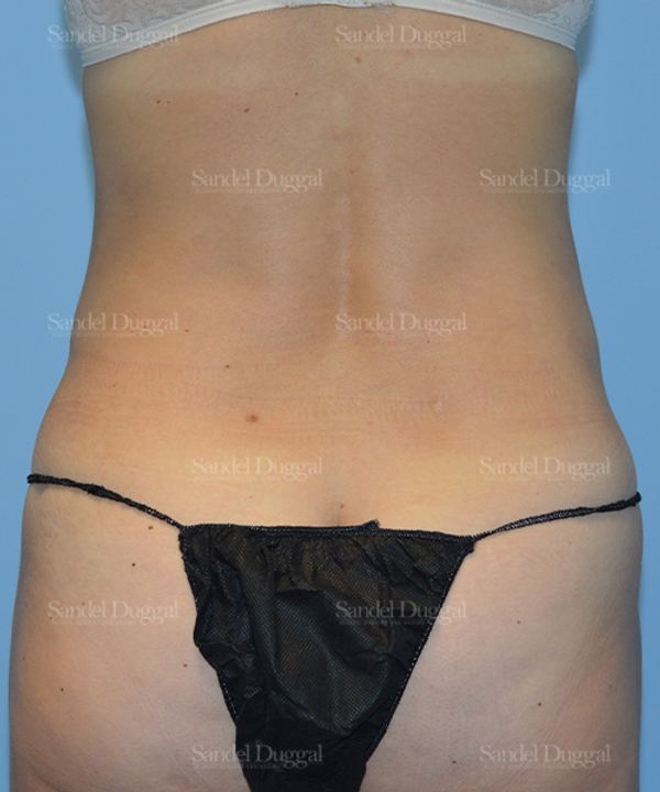 Liposuction — Legs & Flanks after, case 2526
