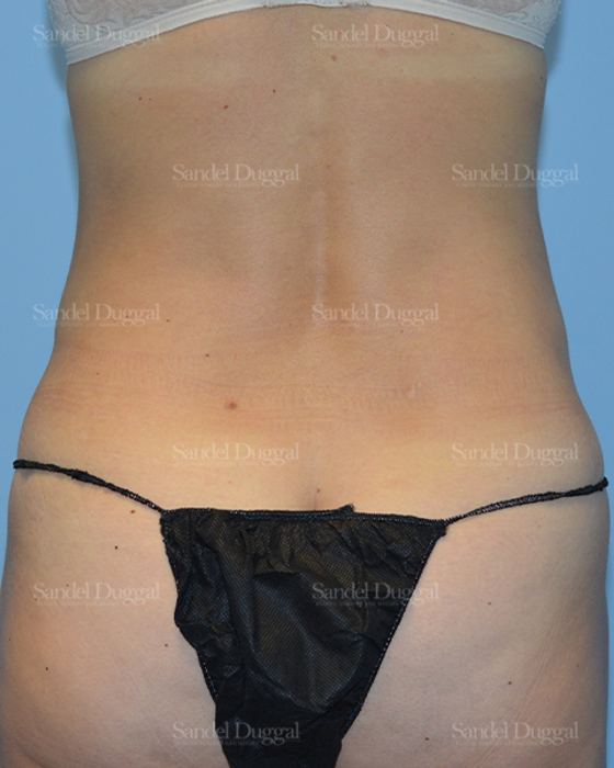 Liposuction — Legs & Flanks after, case 2526
