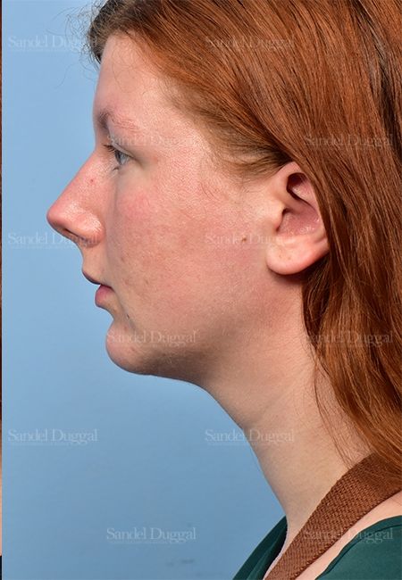 Neck & Chin Liposuction after, case 5365