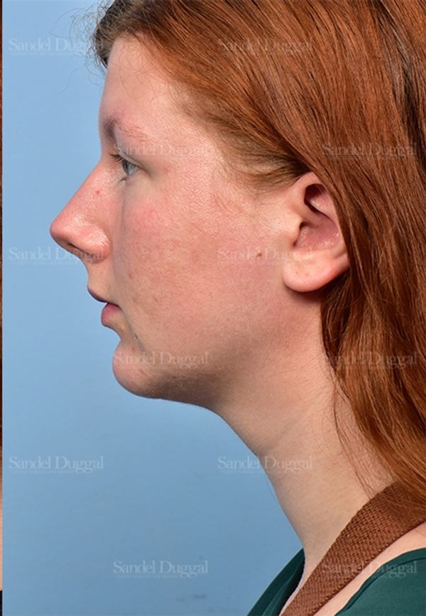 Neck & Chin Liposuction after, case 5365