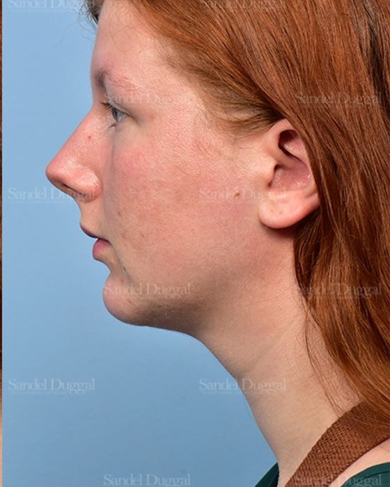 Neck & Chin Liposuction after, case 5365