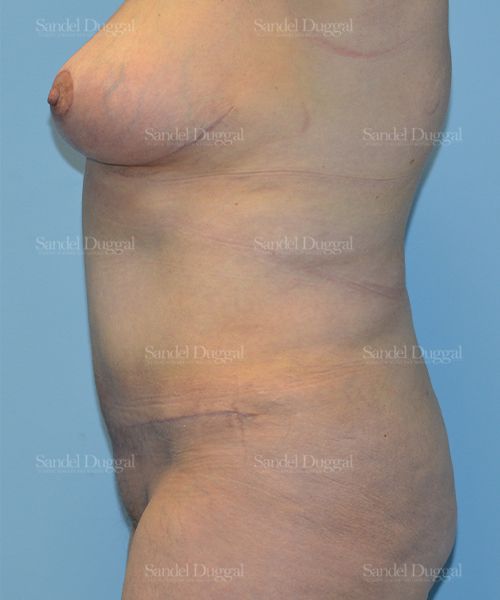 Tummy Tuck after, case 1533