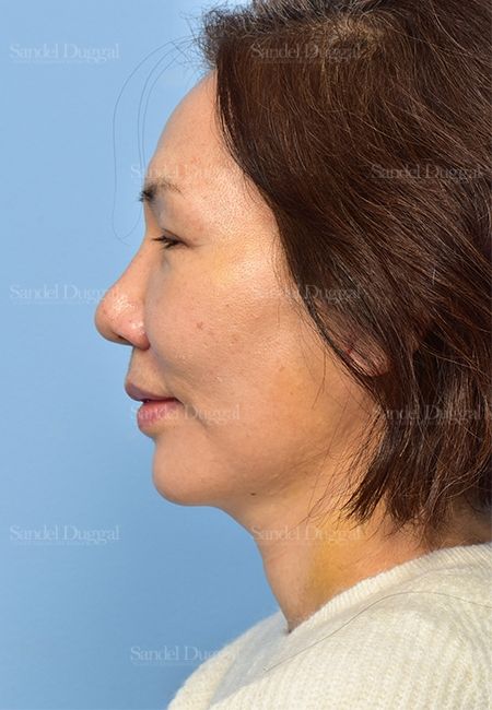 Facelift after, case 5330