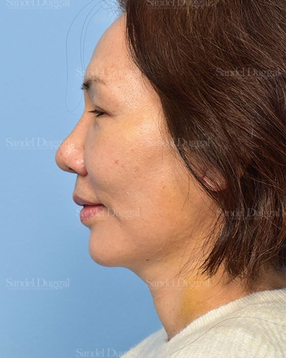 Facelift after, case 5330