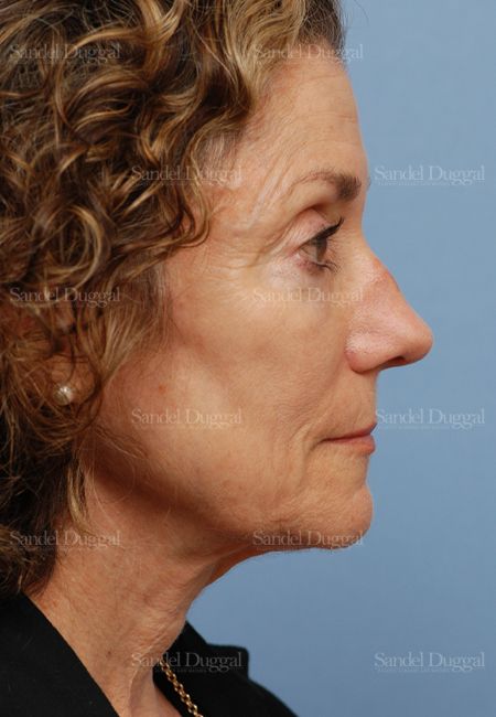 Rhinoplasty before, case 2845
