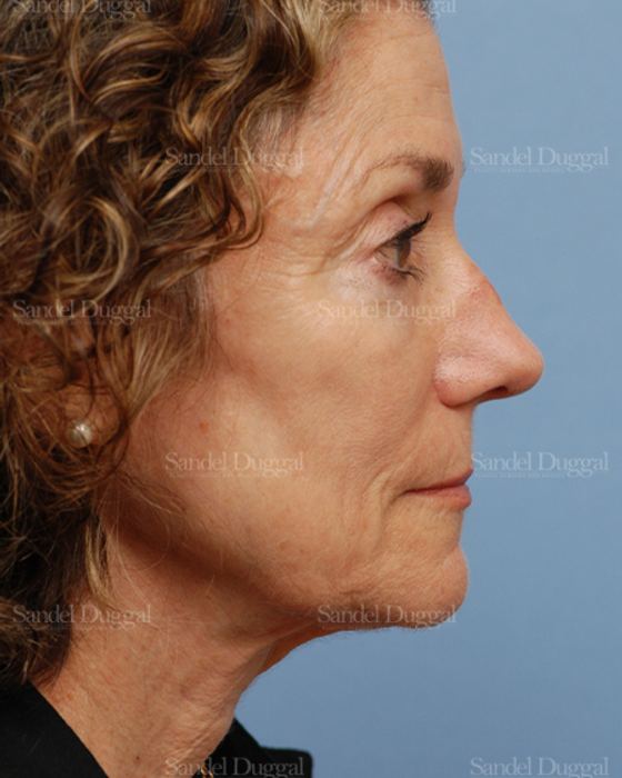 Rhinoplasty before, case 2845
