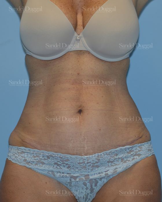 Tummy Tuck after, case 1599
