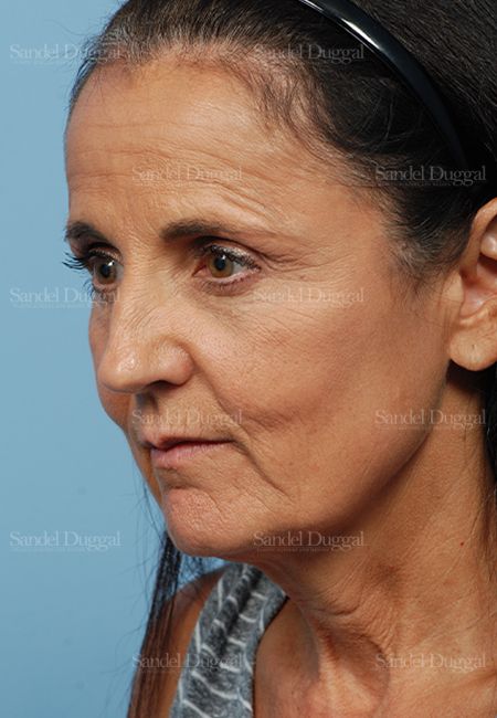 Facelift before, case 2661
