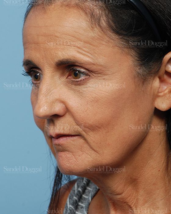 Facelift before, case 2661