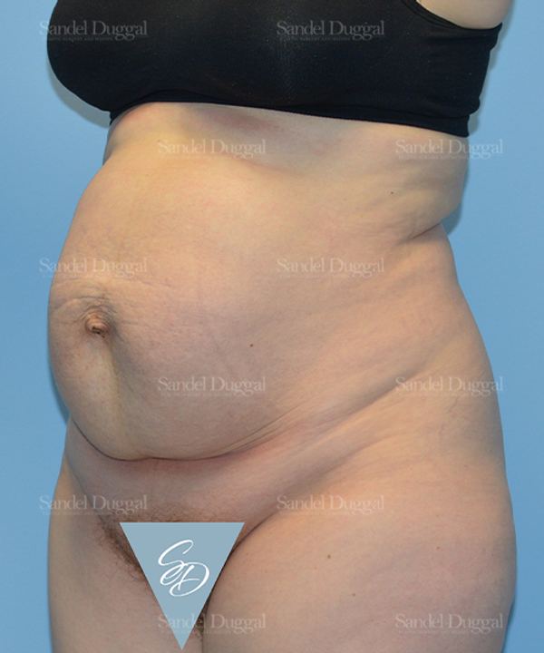 Tummy Tuck before, case 1666