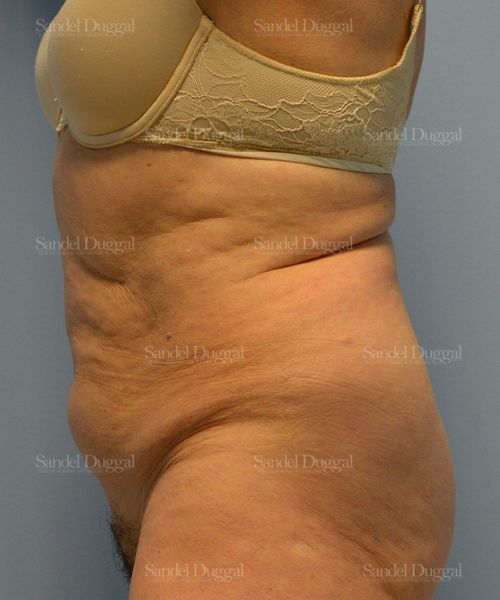 Tummy Tuck before, case 1729