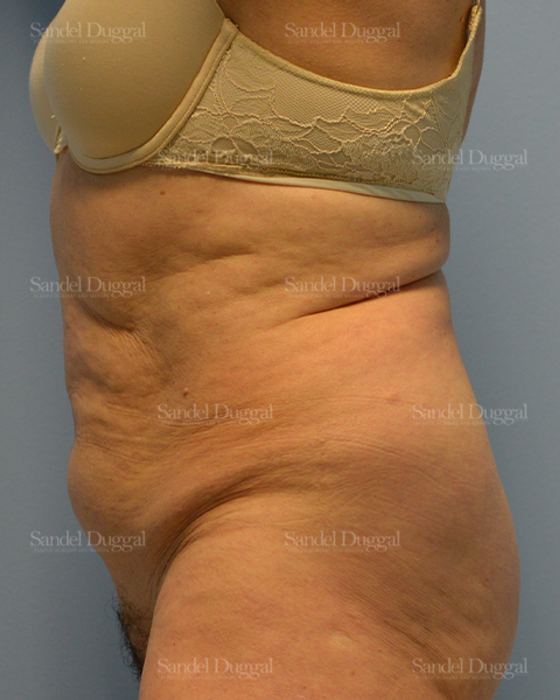 Tummy Tuck before, case 1729