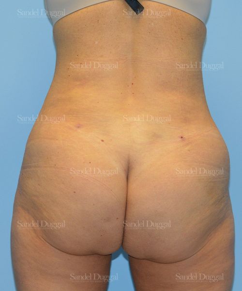 Tummy Tuck after, case 1599