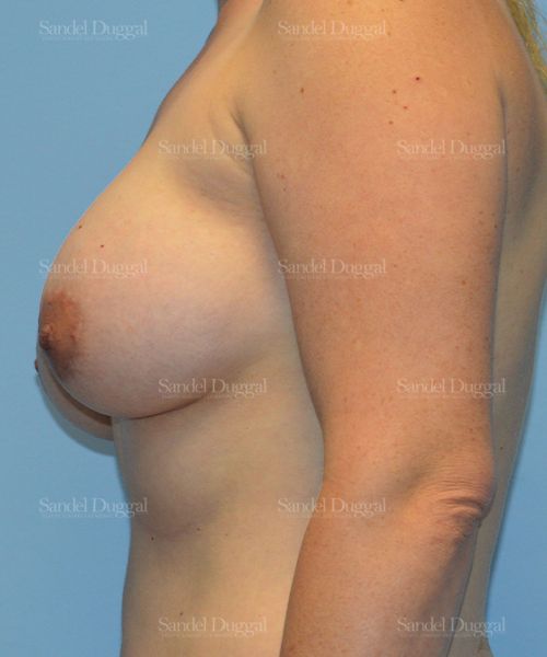 Breast Augmentation with Lift after, case 3456