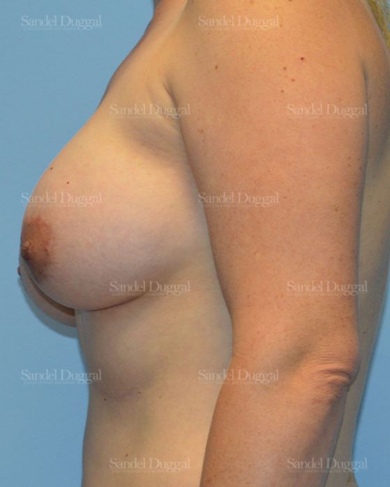 Breast Augmentation with Lift after, case 3456