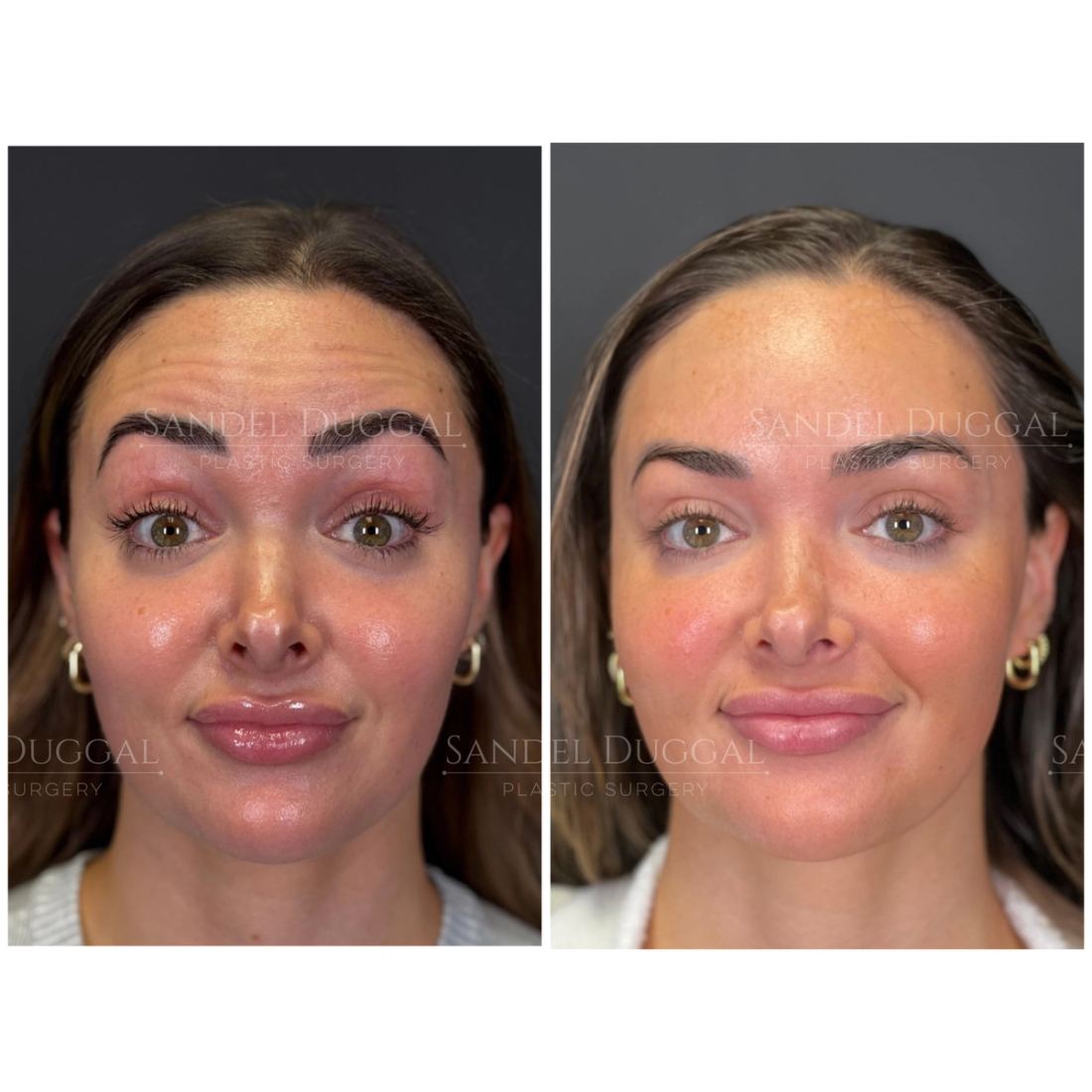 Botox & Fillers before and after, case 6007