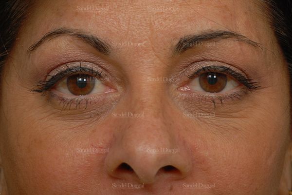 Eyelid Rejuvenation after, case 1922