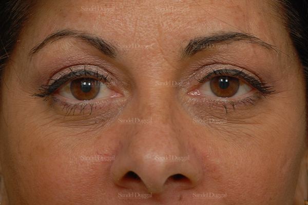 Eyelid Rejuvenation after, case 1922