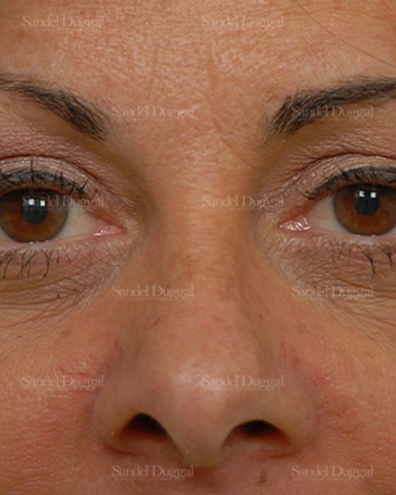 Eyelid Rejuvenation after, case 1922