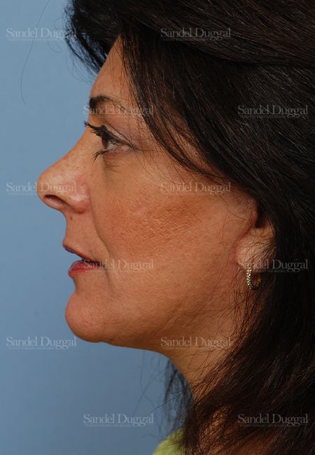 Facelift after, case 2671