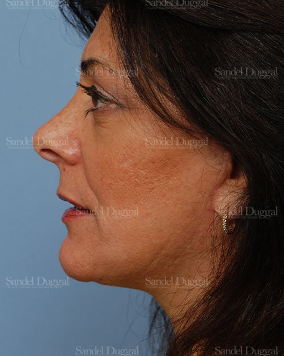 Facelift after, case 2671