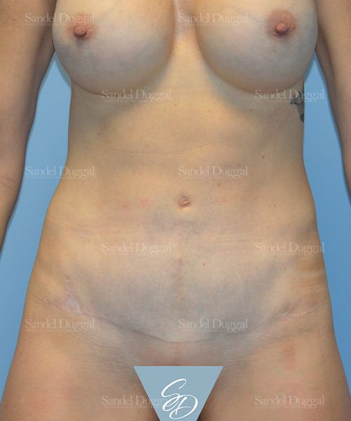Tummy Tuck after, case 1540