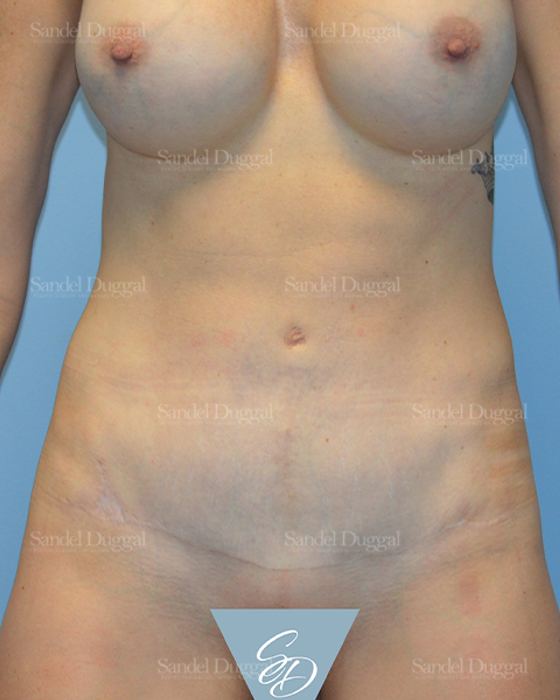 Tummy Tuck after, case 1540