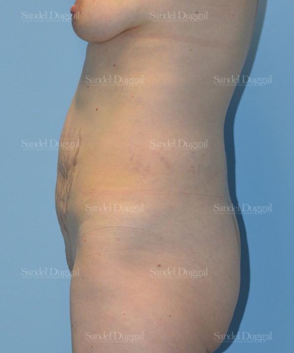 Tummy Tuck before, case 1659