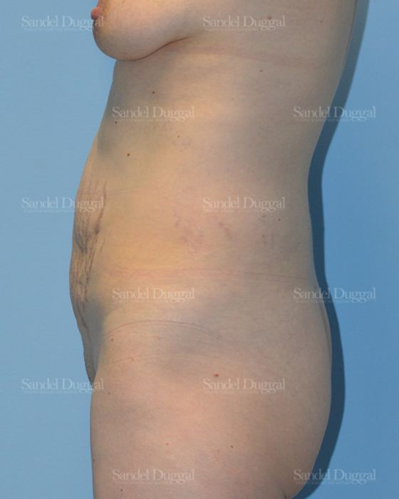 Tummy Tuck before, case 1659