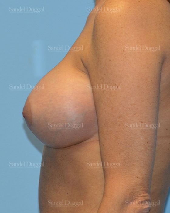 Breast Augmentation with Lift after, case 3435