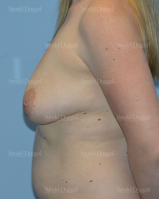 Breast Augmentation with Lift before, case 3428