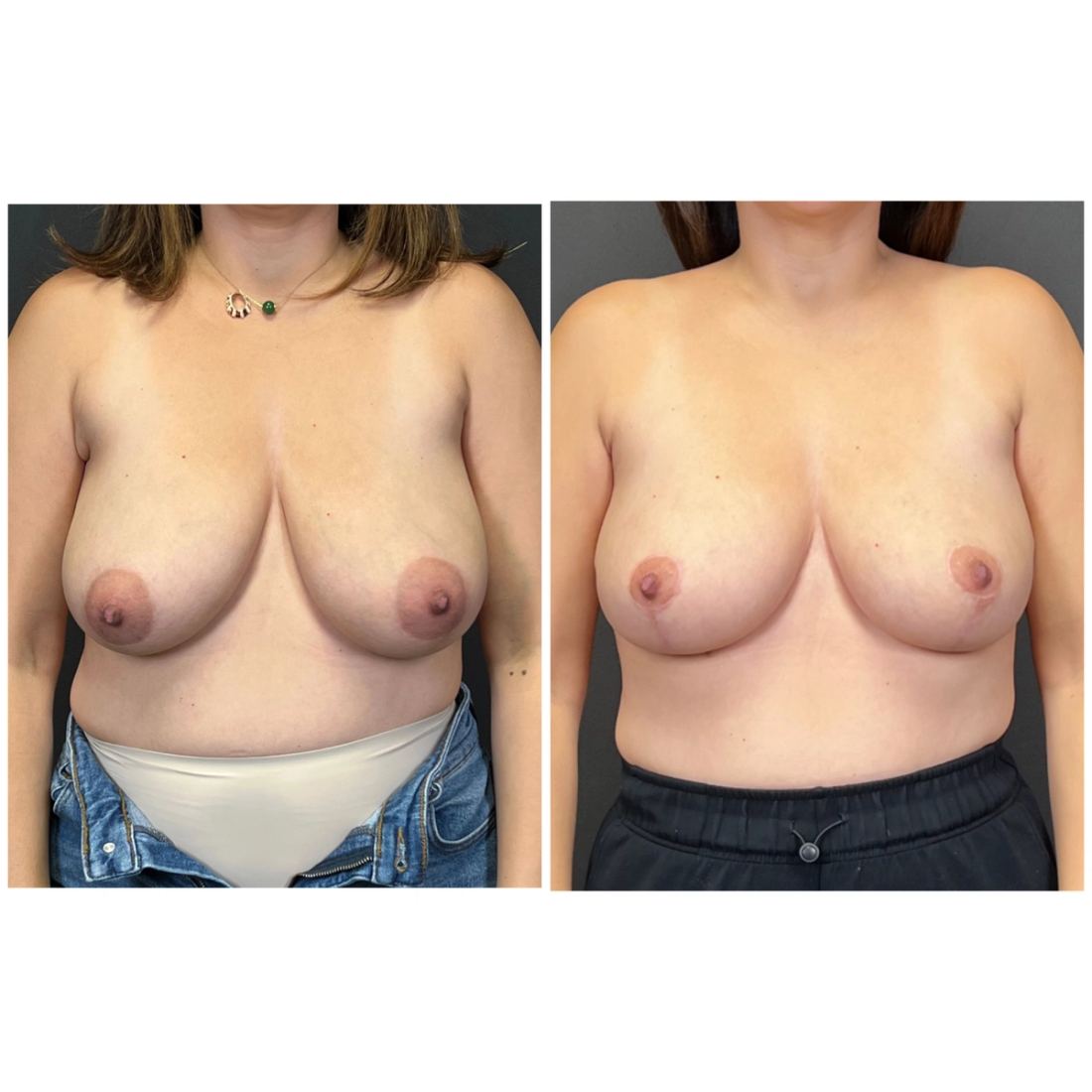 Breast Lift before and after, case breast-lift-new-09