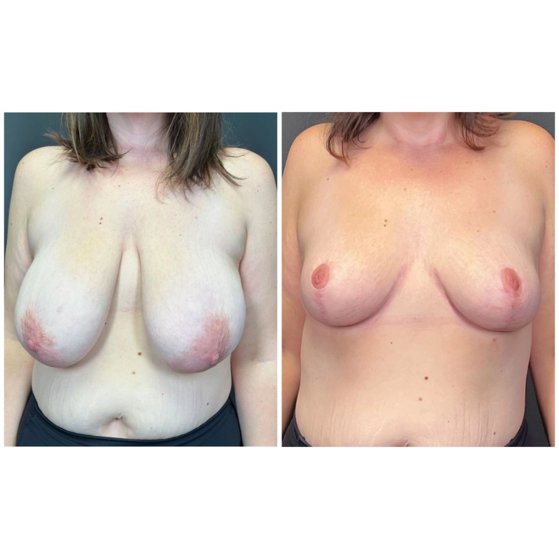 Breast Lift before and after, case breast-lift-new-06