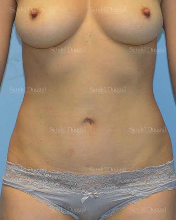 Tummy Tuck after, case 1608