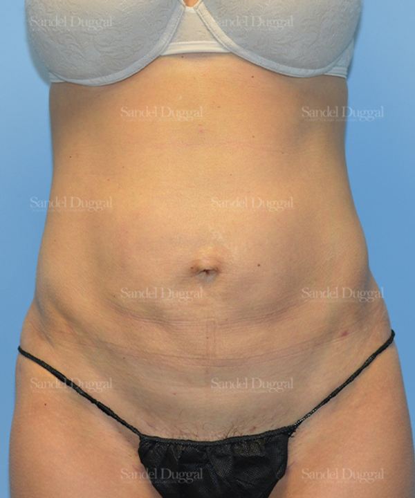 Liposuction — Abdomen after, case 2474