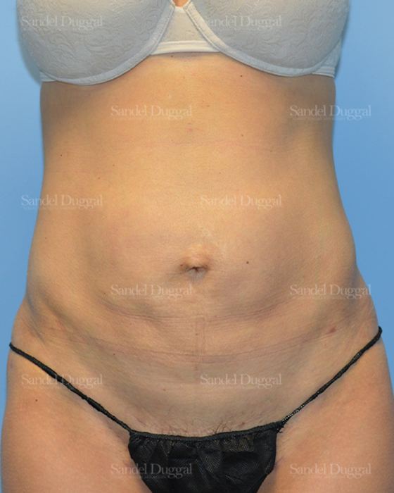 Liposuction — Abdomen after, case 2474