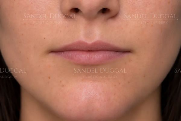 Lip Filler before, case 6014