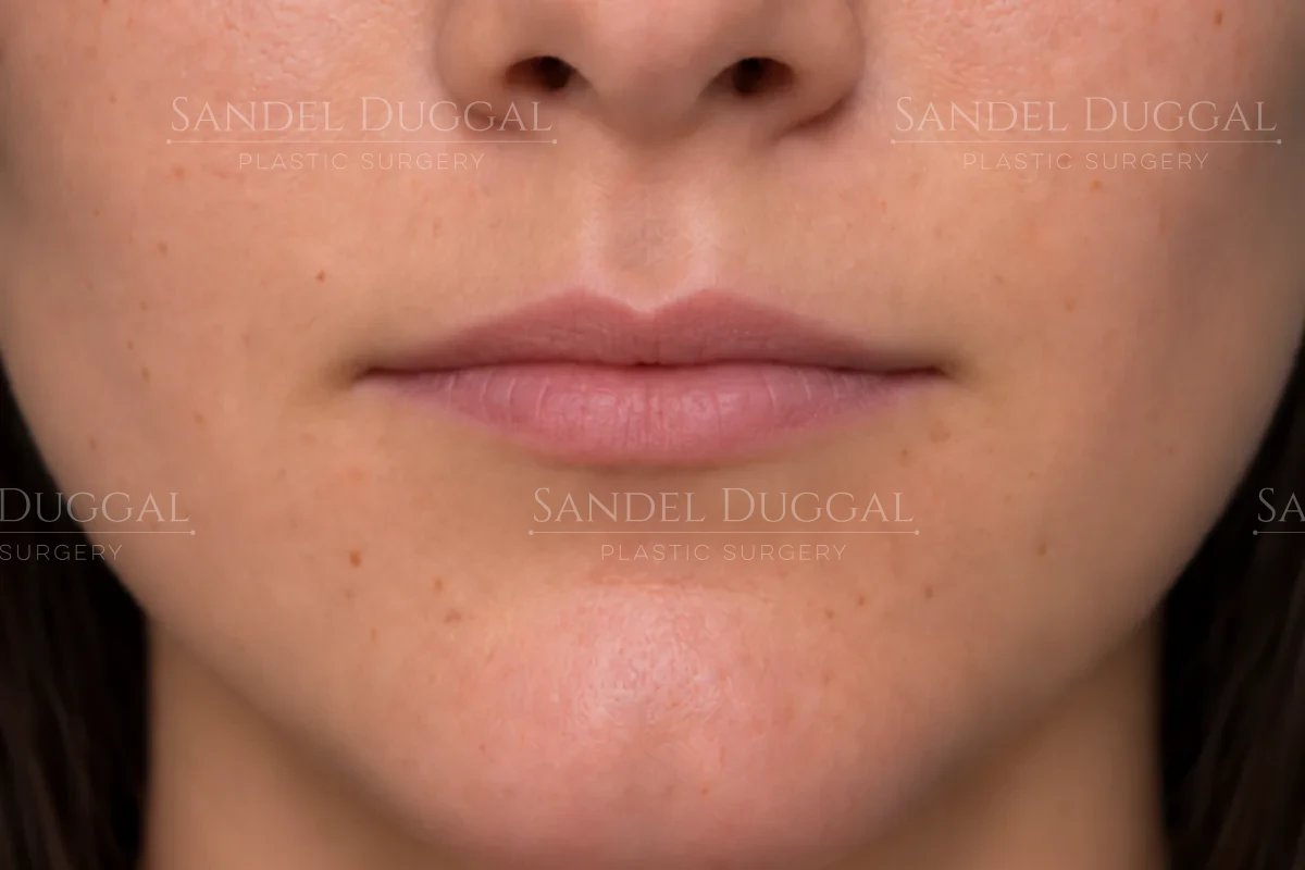 Younger patient's lips before lip filler